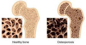 osteoporoza kosti